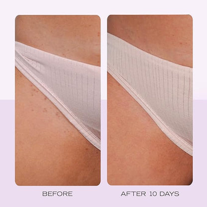 First Aid Beauty Ingrown Hair Pads with BHA + AHA – 28 pads