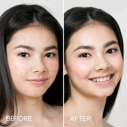 Acne Patches – Marée